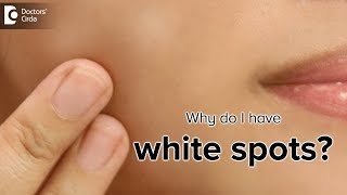 What is the cause of white spots on the skin  Dr Rasya Dixit [upl. by Nollahp]