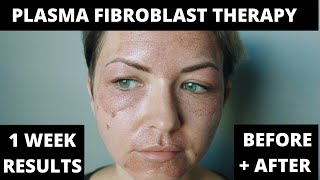 PLASMA PEN FIBROBLAST THERAPY PROCESS  1 WEEK RESULTS BEFORE amp AFTER  SKIN TIGHTENING [upl. by Atsylac]