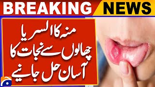 Quick amp Easy Solutions to Get Rid of Mouth Ulcers amp Blisters Naturally  Home Remedies [upl. by Bunni]