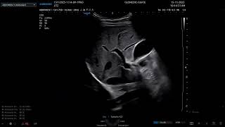 Examen de abdomen con US y Doppler TransCraneal de Adulto con el v6 sw v10400c [upl. by Massarelli268]