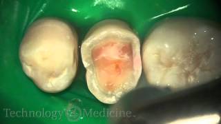 Dental Laser  Crown Prep Extracted [upl. by Nihi]