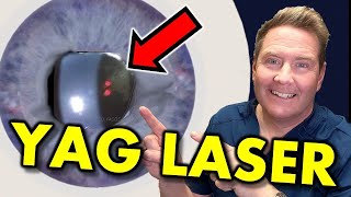 YAG Capsulotomy Laser Eye Treatment What Is It and How Painful Is It [upl. by Lomaj581]