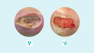 How to assess wound exudate [upl. by Ilocin804]