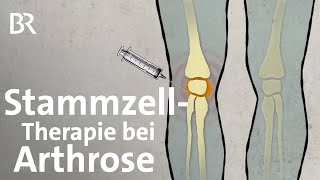 StammzellTherapie bei Arthrose Neue Behandlungsmethoden bei Knieschmerzen  Gut zu wissen  BR [upl. by Evita]