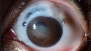 RHEUMATOID ARTHRITS amp EYE SCLERITIS [upl. by Camellia]