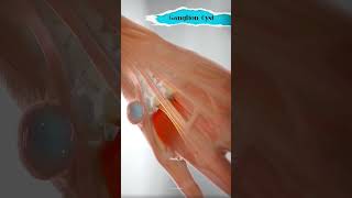 Ganglion Cyst Removal shorts ganglioncyst ganglion [upl. by Nac591]