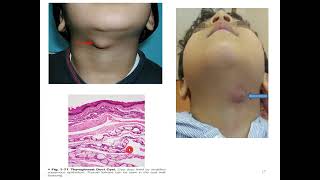 Lecture 8  Non odontogenic cyst [upl. by Notlem887]