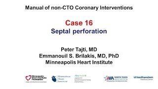 Case 16 PCI Manual  Septal perforation [upl. by Akiehsat]