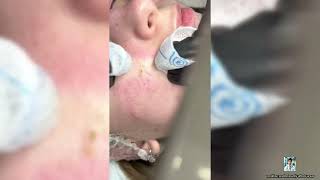 Ultimate Pimple Popping 2024 Amazing Blackhead Removals [upl. by Leisam176]