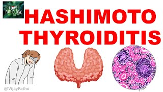 Hashimoto Thyroiditis Etiopathogenesis Gross m Microscopy and Clinical Features [upl. by Jonathan]