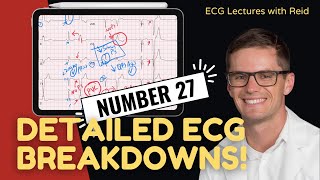 EKG Test Yourself  ECG Case Study 27 [upl. by Easton]