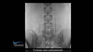 Ovarian Vein Embolisation [upl. by Etrem648]