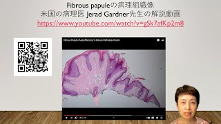 fibrous papule病理組織像 [upl. by Harwilll]