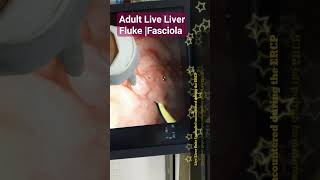 Adult Live Liver Fluke Fasciola found during ERCP [upl. by Stegman436]