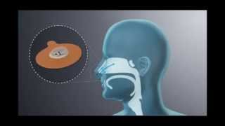 What is Provent Sleep Apnea Therapy amp How Does it Work [upl. by Haymo209]