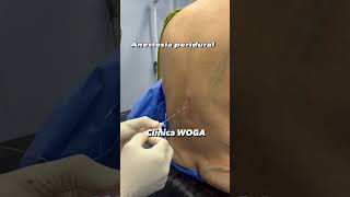 Anestesia en abdominoplastia con lipoescultura anestesiaperidural anestesia [upl. by Shute]