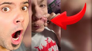 Popping huge blackheads and Giant Pimples Best Pimple Popping Videos [upl. by Hadsall]