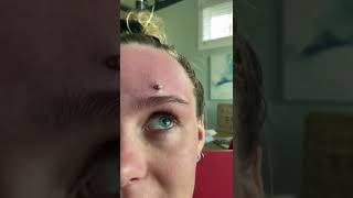 Cystic Acne Extractions Whiteheads  Blackheads Removal Today [upl. by Aanas850]