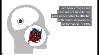 Interplay of cell types in cerebral cavernous malformation [upl. by Bega]