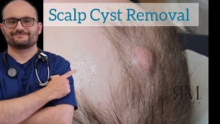 Scalp cyst removal by RPM Health rpmhealthclinic [upl. by Feodore]