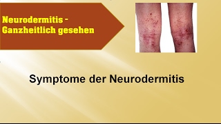 Symptome der Neurodermitis  Ganzmedizin Naturheilpraxis [upl. by Sidras]