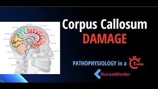 Pathophysiology for Nursing Corpus Callosum and the Nervous System [upl. by Quenna]