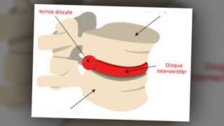 Hernie discale  symptômes et traitements [upl. by Mariel]