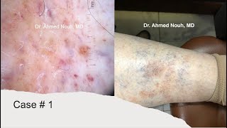 Pigmented purpuric dermatoses Dermatological spectra [upl. by Minabe]