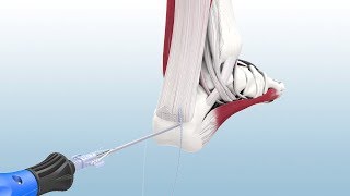 Haglunds Excision and Achilles Reconstruction Using the CuffLink™ System  CONMED Animation [upl. by Ellenaej]