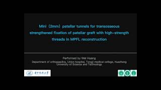 Minipatellar Tunnels for Transosseous Fixation of Medial Patellofemoral Ligament Graft Using High st [upl. by Ariahs554]