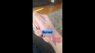 Oil Burn Basic First Aid Steps You Need To Know ✨ [upl. by Rafter]