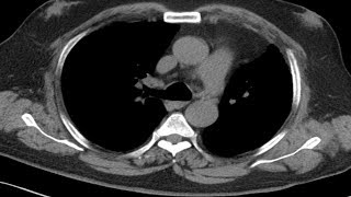 Cross sectional and imaging anatomy of the thorax [upl. by Enimsay]