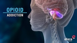 What is Opioid Addiction Animation Video Answers the Question [upl. by Coates796]