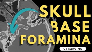 Skull Base Foramina  Radiology anatomy part 1 prep  CT imaging of skull base [upl. by Donni]