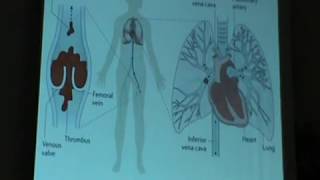 Pulmonary Embolism part one [upl. by Odelinda]