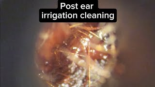 Earwax cleaning 20 post water irrigation [upl. by Early]