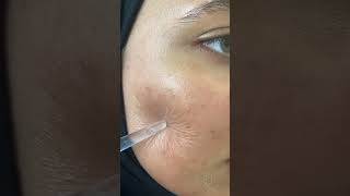 Green peel 🤌🏻 اكسبلور ديرمابن skincare ميزوثيرابي بلازما beauty تجميل [upl. by Adriano]