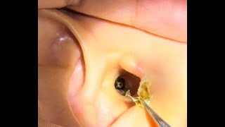 Earwax Removal ASMR Earwax Too much earwax causes blockage in both ears 👂👂 [upl. by Reichel]