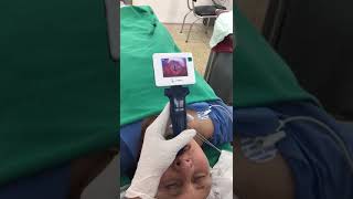 Video Laryngoscopy intubation for an Adult Patient [upl. by Notserp]