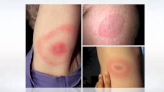 Lyme Disease Pictures  wikiSymptoms [upl. by Anirba]