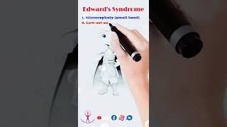 Mnemonic Edwards Syndrome neet fmge usmle biology [upl. by Dami747]