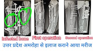 FEMUR OPEN COMPOUND FRACTURE INFECTED NONUNION CASE TREATMENT IN DESHWAR HOSPITAL BHARATPUR [upl. by James665]