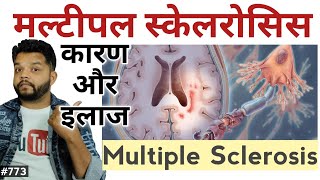 मल्टीपल स्केलरोसिस  कारण और इलाज  Multiple Sclerosis Causes Symptoms Diagnosis amp Treatment [upl. by Algie]