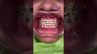 ¡🔥Frenillos metálicos con dientes FALSOS🔥 [upl. by Micheal485]