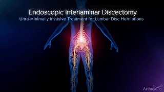 Interlaminar Approach to Disc Herniation Treatment [upl. by Marisa]