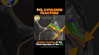 Fig 2E19 PCL Bony avulsion at tibial insertion [upl. by Beaver127]