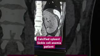 Calcified spleen Sickle cell anemia spleen anemia ctscan calcification radiology coreim [upl. by Ecirtemed873]