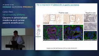 Glycosylation in cancer [upl. by Barrett]