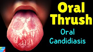 Oral Thrush  Oral Candidiasis – Symptoms Causes Diagnosis Treatment Complications [upl. by Cocks1]