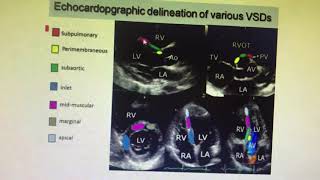 Echocardiogram division of types of VSD [upl. by Celtic]